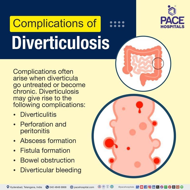 Complications of Diverticulosis Common Complications of Diverticulosis | Diverticulosis Complications