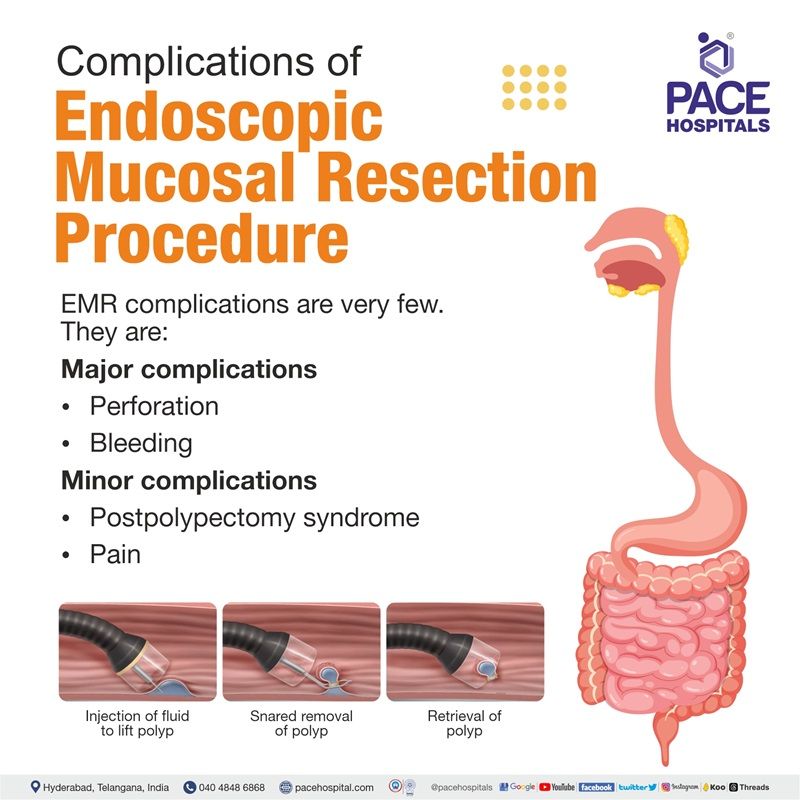 endoscopic mucosal resection complications | endoscopic mucosal resection colon polyps barrett's esophagus | endoscopic mucosal resection doctors in Hyderabad, India | endoscopic mucosal resection near me
