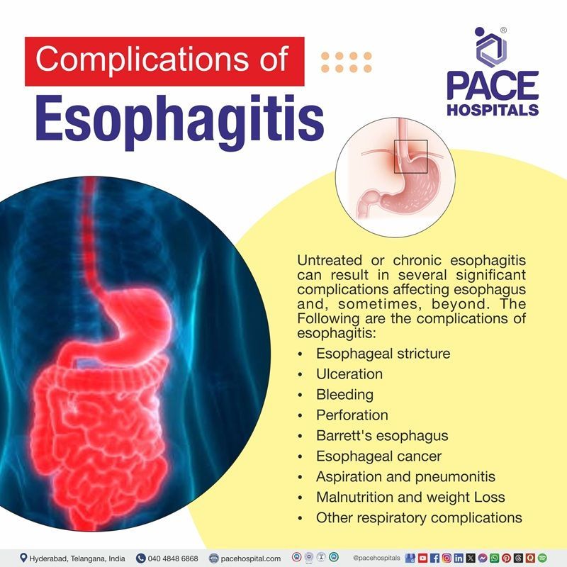 Complications of Esophagitis Complications of Esophagitis | Esophagitis Complications