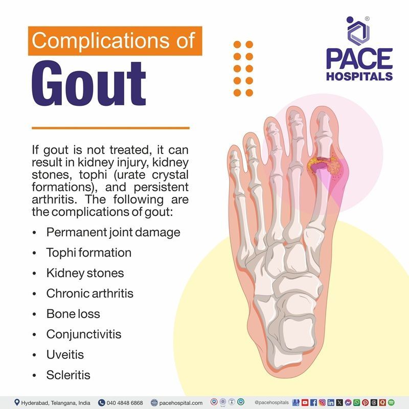 Complications of Gout | Gout Complications
