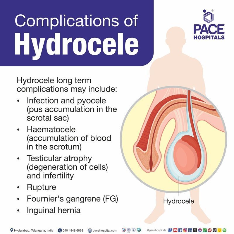 hydrocele complications​ | What are the complications of hydrocele | hydrocele after surgery complications​ | Visual depicting the complications of Hydrocele