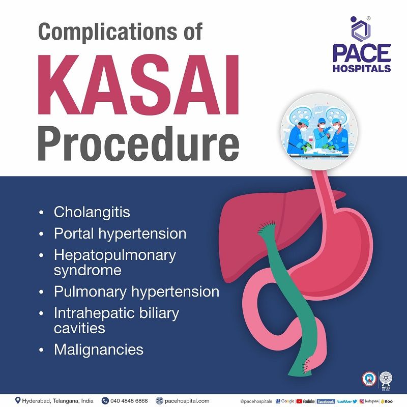 kasai procedure complications | liver transplant after kasai procedure | biliary atresia failed kasai procedure | kasai procedure liver