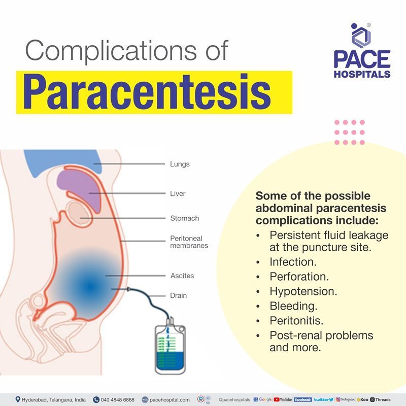 abdominal paracentesis complications | ascites tapping complications | ascitic fluid tapping complications | complications of ascites tapping procedure