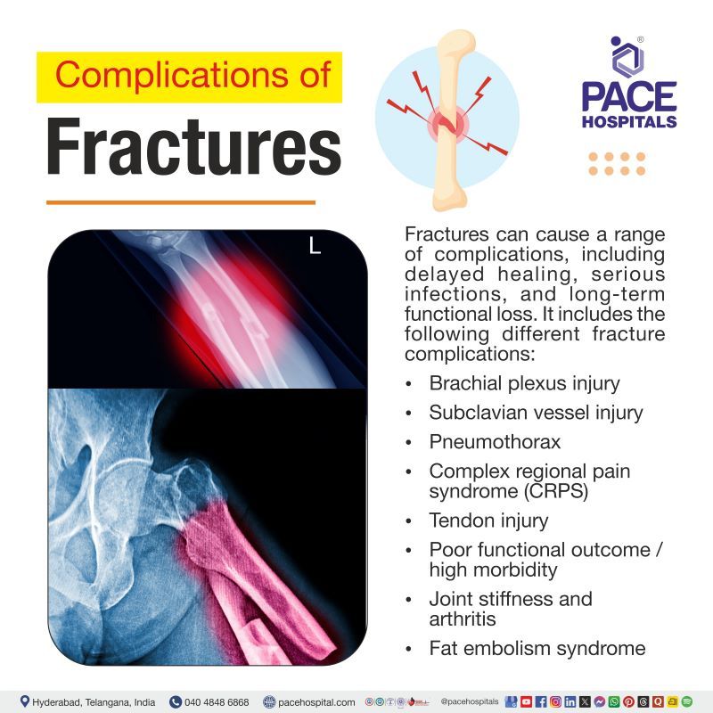 Complications of Fracture Complications of Fracture | Fractures complications