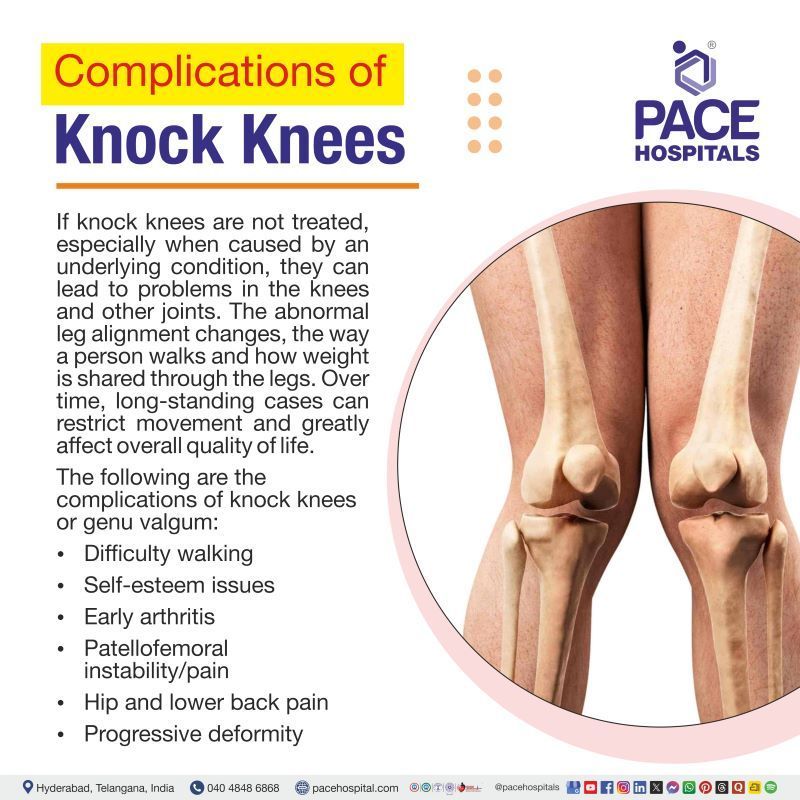 Knock knees Complications | Complications of genu valgum | Genu valgum complications | Complications of Knock knees