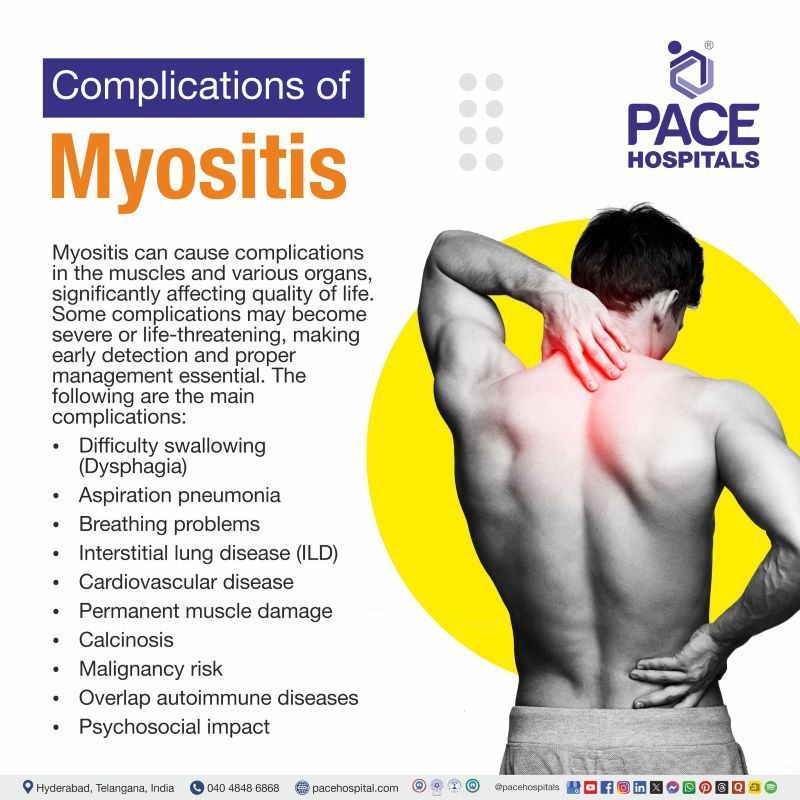 Complications of Myositis Complications of Myositis | Myositis complications