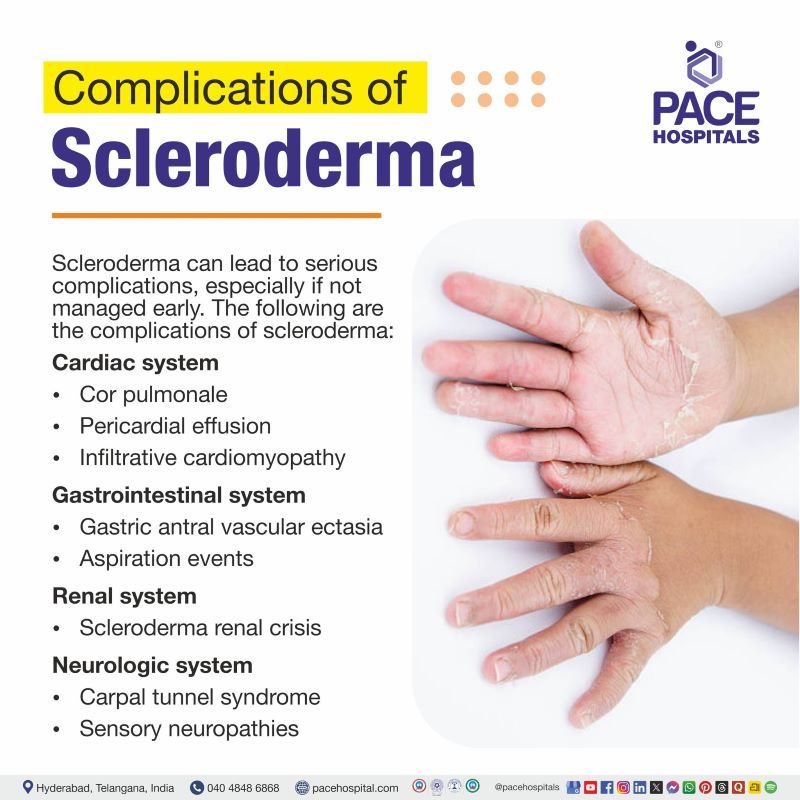 Complications of Scleroderma Complications of Scleroderma | Scleroderma Complications