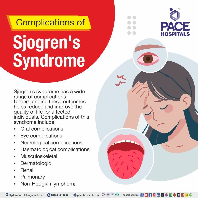 Complications of Sjogren's Syndrome Complications of Sjogren's Syndrome | Sjogren's complications | Sjogren's syndrome complications