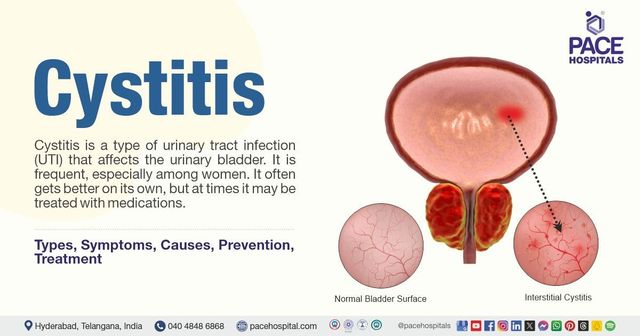 Cystitis - Types, Symptoms, Causes, Prevention, Treatment