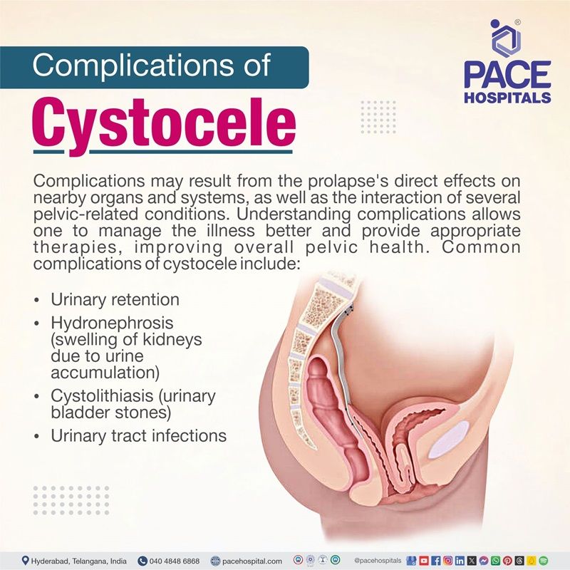 cystocele complications | complications of cystocele | What are the complications of Cystocele | Visual revealing the complications of Cystocele
