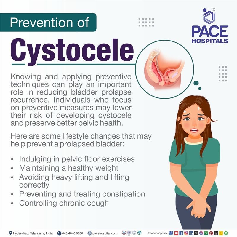 Cystocele (Prolapsed Bladder) - Symptoms, Causes and Treatment