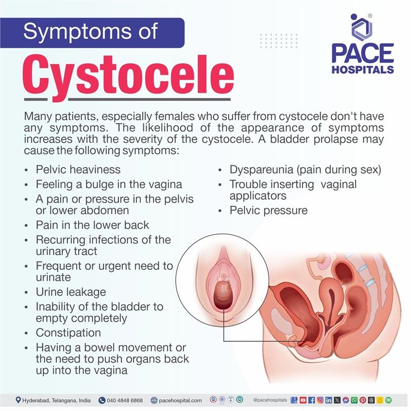 cystocele symptoms | cystocele prolapse symptoms | male cystocele symptoms | Symptoms of Cystocele | Visual showing the symptoms of Cystocele