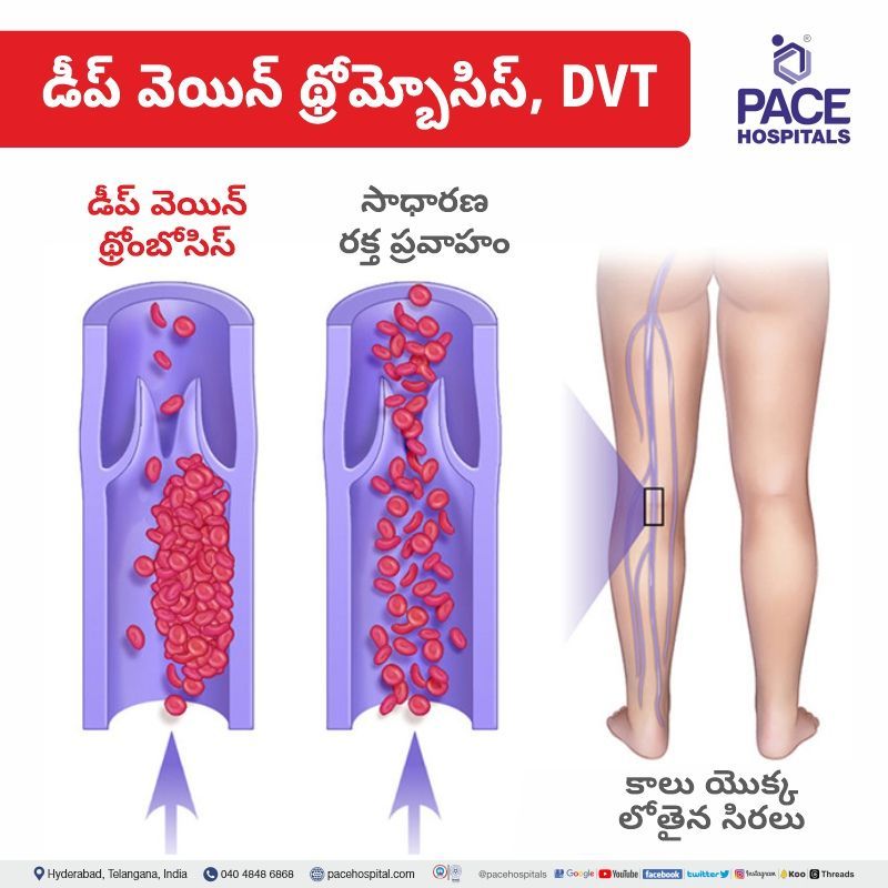 Deep Vein Thrombosis DVT treatment in telugu | Deep Vein Thrombosis DVT in telugu