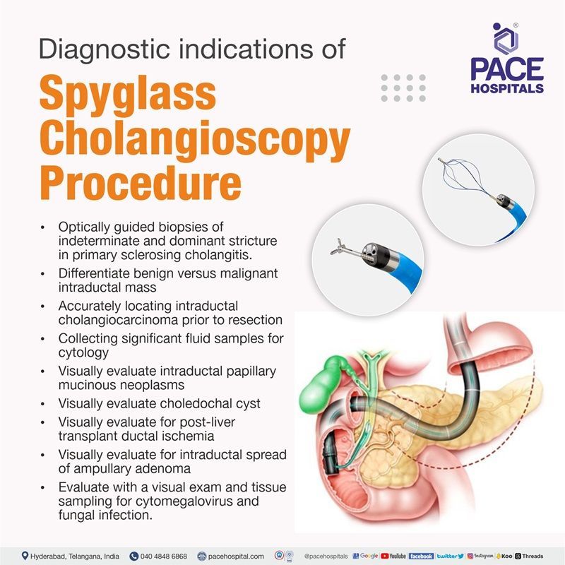 Diagnostic Indications for Spyglass Cholangioscopy Procedure | Best Hospital for Spyglass Cholangioscopy Procedure in Hyderabad, India