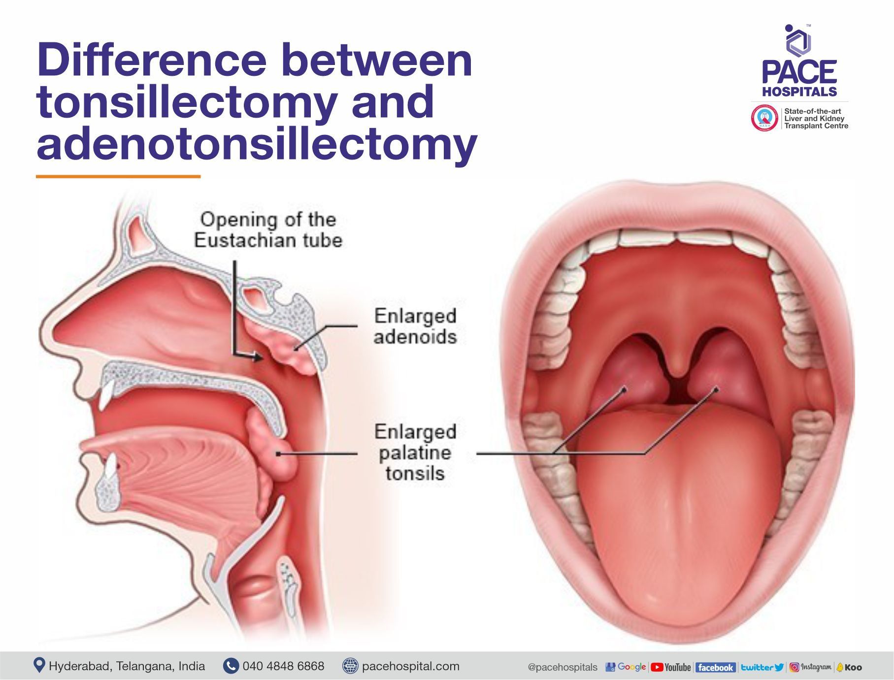 Difference between tonsillectomy and adenotonsillectomy | Pace Hospitals