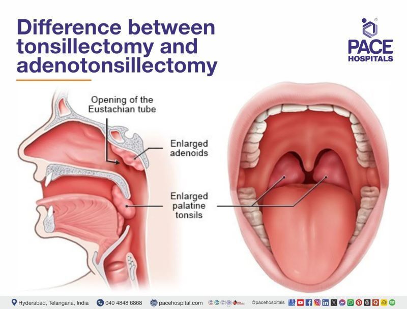 Difference between tonsillectomy and adenotonsillectomy | Pace Hospitals Difference between tonsillectomy and adenotonsillectomy | Pace Hospitals