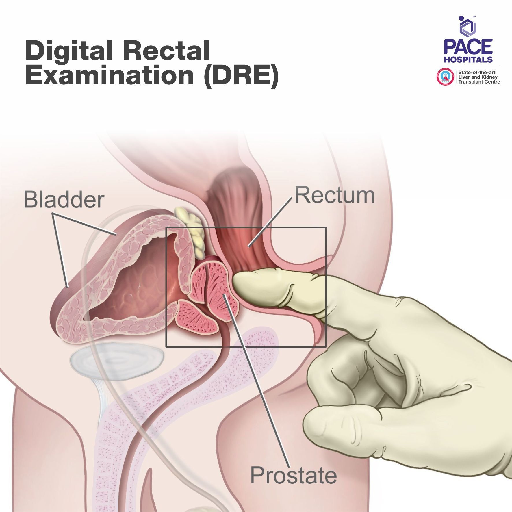 Digital rectal examination (DRE)
