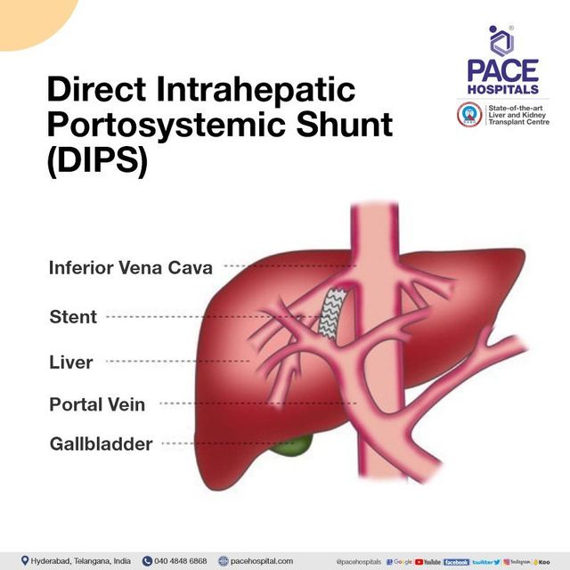 Transjugular Intrahepatic Portosystemic Shunt Diagram