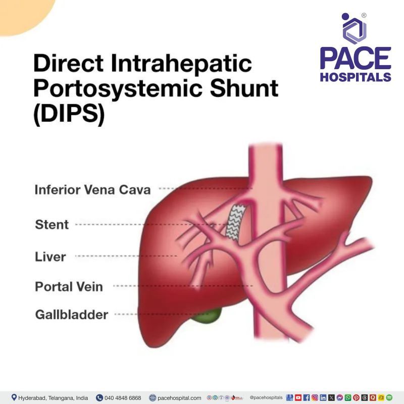 Direct Intrahepatic Portosystemic Shunt (DIPS) Direct Intrahepatic Portosystemic Shunt (DIPS)