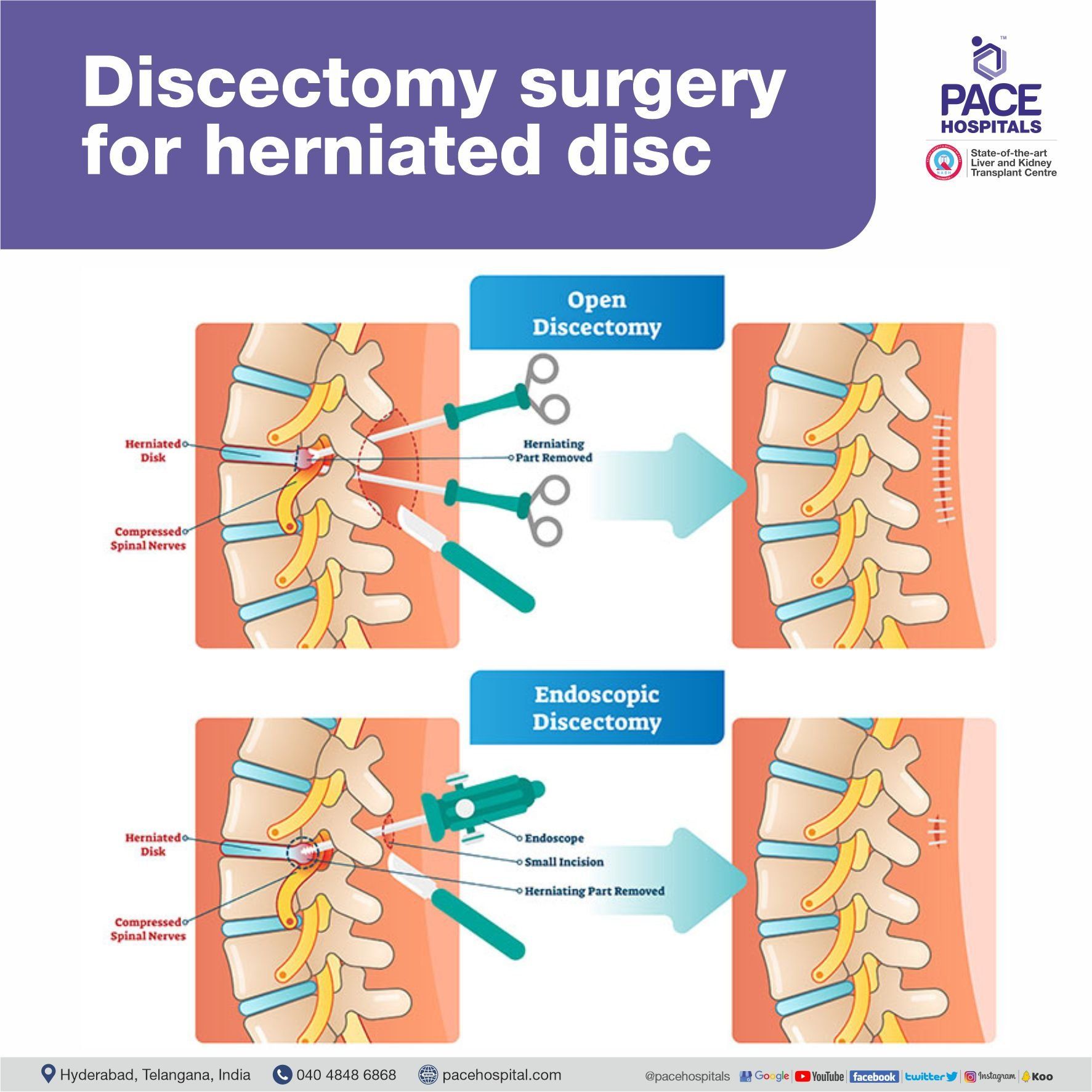 Discectomy surgery for herniated disc in Hyderabad, Telangana, India