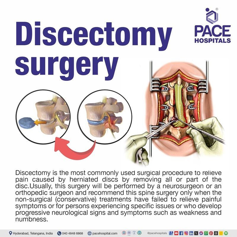 Discectomy surgery​ meaning | Discectomy surgery in Hyderabad | best Discectomy surgery hospitals in Hyderabad India