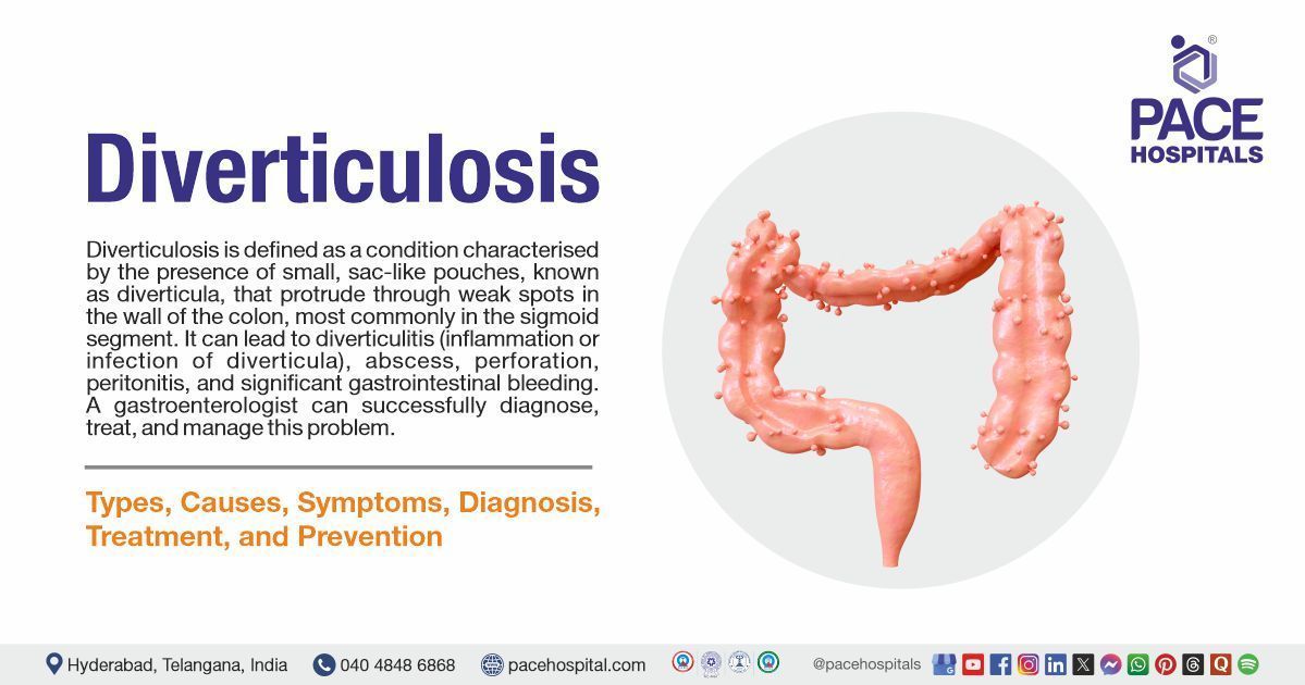 Diverticulosis symptoms & Causes | Diverticulosis treatment in India | What is Diverticulosis 