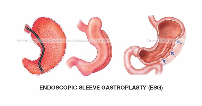 Endoscopic Sleeve Gastroplasty (ESG)