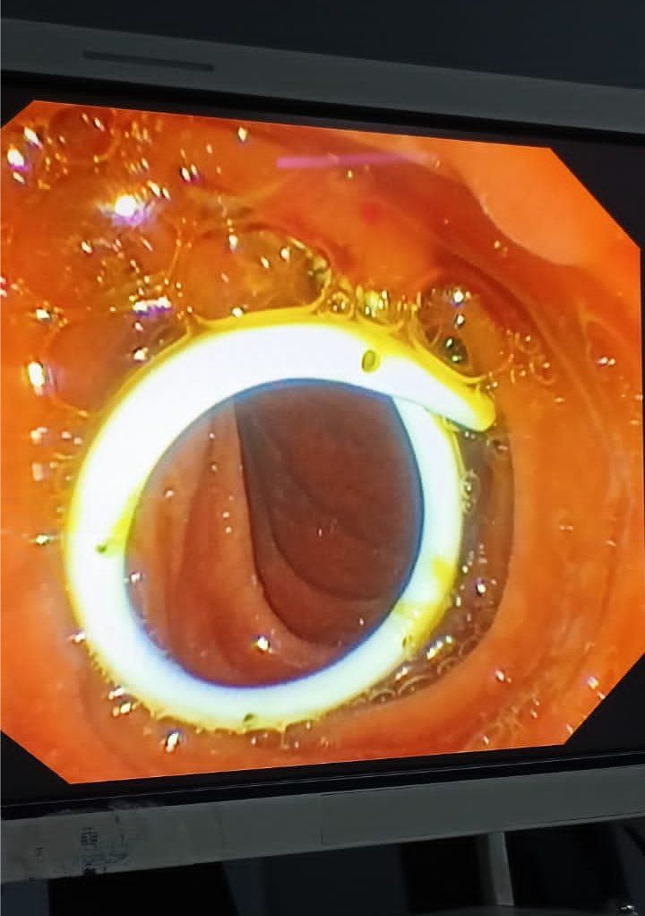 ERCP was done with successful removal of CBD stone