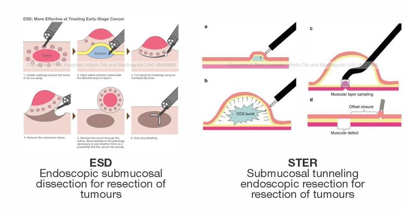 ESD (Endoscopic submucosal dissection for resection) and STER (Submucosal tunneling endoscopic resection)