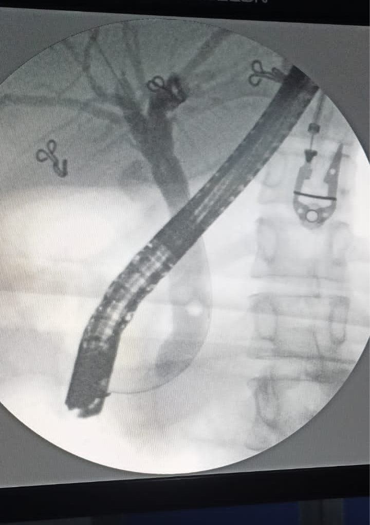 EUS done suggestive of stone in the distal CBD