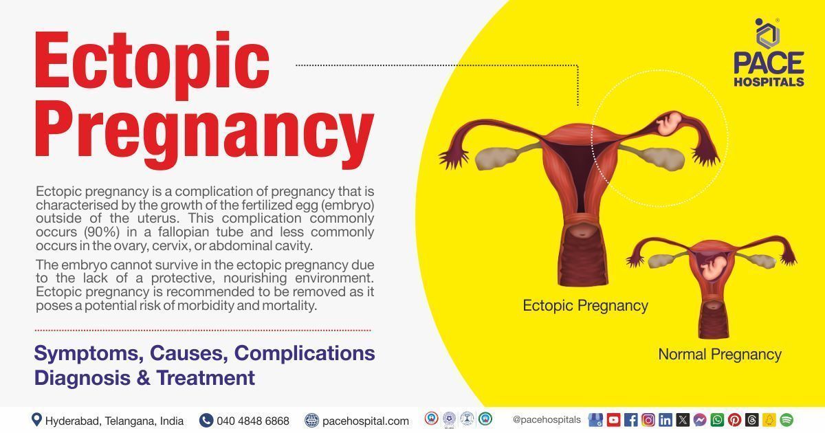 Ectopic Pregnancy Causes, Symptoms, Types and Treatment