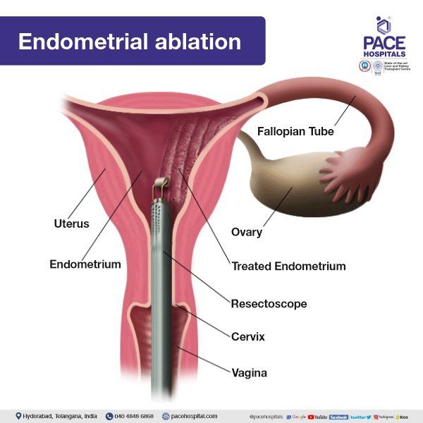 Endometrial Ablation in Hyderabad | Uterine Ablation | Uterine Fibroids Treatment