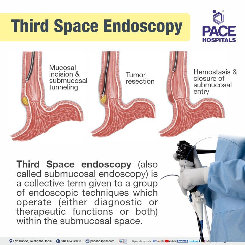 What is Third Space Endoscopy technique | Best Hospital for Endoscopic Resection and Third Space Endoscopy in Hyderabad, India | Third Space Endoscopy near me