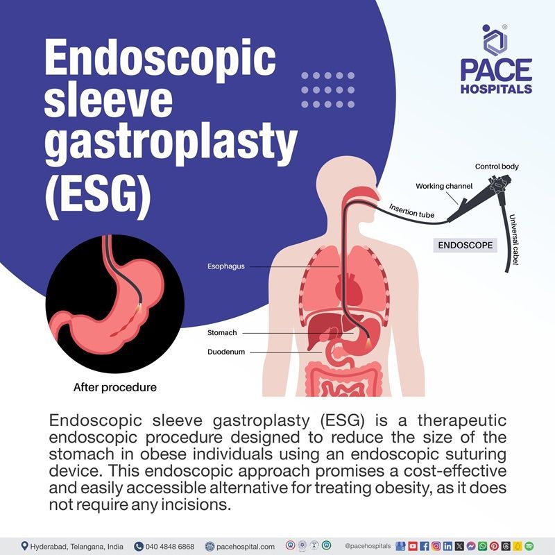 endoscopic sleeve gastroplasty ESG definition | ESG endoscopic sleeve gastroplasty price in Hyderabad | Best Endoscopic Sleeve Gastroplasty hospital in Hyderabad India