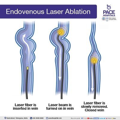 endovenous laser ablation in hyderabad |  varicose vein surgery - laser ablation varicose veins