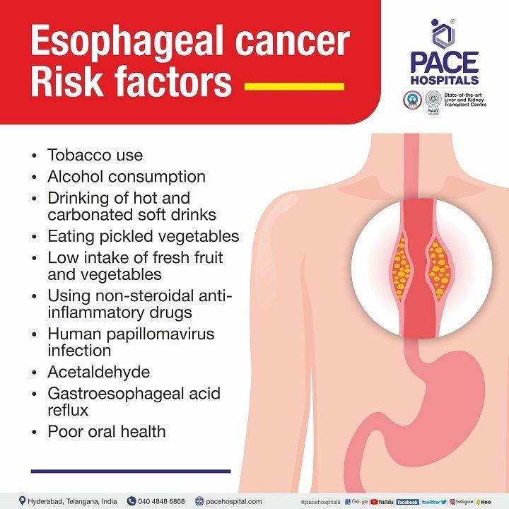 esophageal cancer causes and risk factors