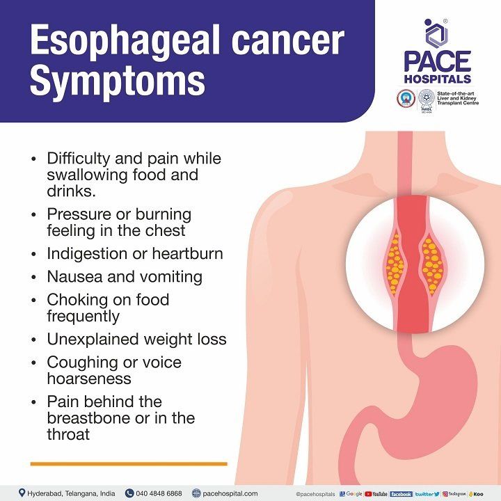early signs and symptoms of esophageal cancer | stage 1 esophageal cancer symptoms