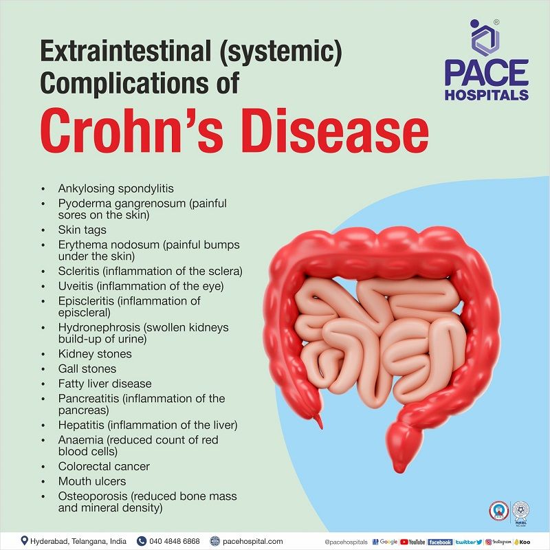 crohn's disease with complications | Extraintestinal systemic complications of Crohn's disease | crohn's disease of small intestine without complications