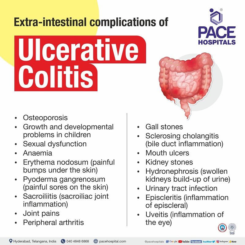 extraintestinal manifestations of ulcerative colitis | ulcerative colitis extraintestinal | most common extraintestinal manifestation of ulcerative colitis | extra intestinal manifestations of ulcerative colitis