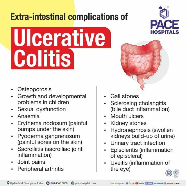 https://lirp.cdn-website.com/69c0b277/dms3rep/multi/opt/Extraintestinal+manifestations+of+ulcerative+colitis-640w.jpg
