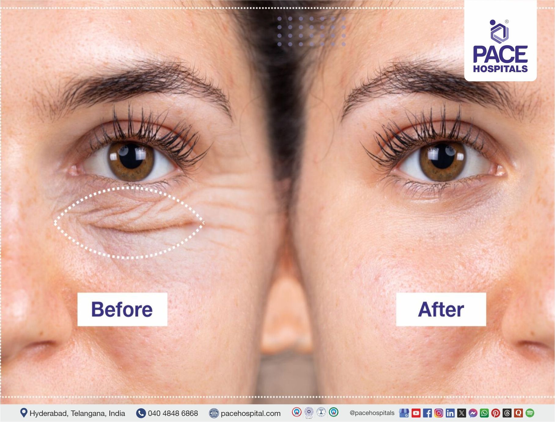 Eyelid Surgery Before and After Blepharoplasty before and after photos | eyelid surgery before and after