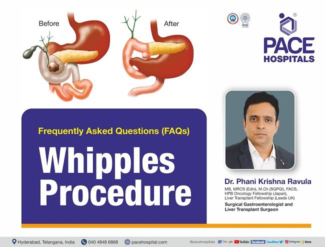 FAQ - Whipple Surgery for Pancreatic Cancer | Whipples Procedure | Dr Phani Krishna Ravula