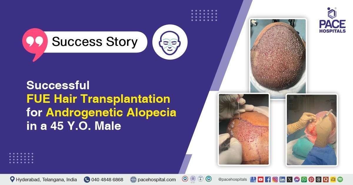 Grade VI baldness Treated with FUE Hair Transplant in 45 YO