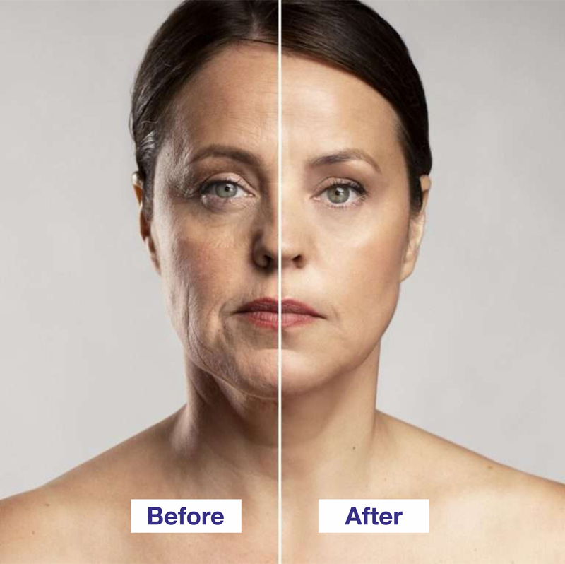 Rhytidectomy Before and After Rhytidectomy before and after | Facelift Surgery before and after in Hyderabad, Telangana, India