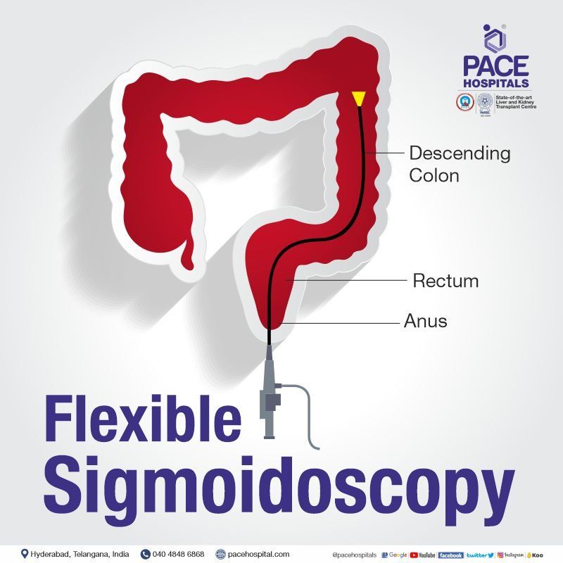 Flexible sigmoidoscopy in Hyderabad | Flexible sigmoidoscopy in India | Flexible sigmoidoscopy | Flexible sigmoidoscopy cost | Flex sigmoid | Flexible fiberoptic sigmoidoscopy