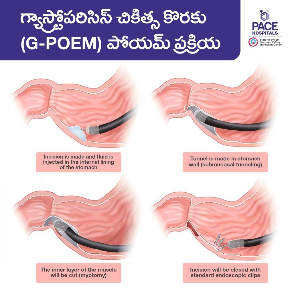 g-poem surgery in telugu, g-poem procedure in telugu, Gastric Peroral Endoscopic Myotomy (G-POEM) for gastroparesis treatment in telugu