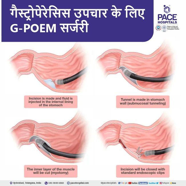 Gastric Peroral Endoscopic Myotomy G-POEM for gastroparesis treatment in Hindi