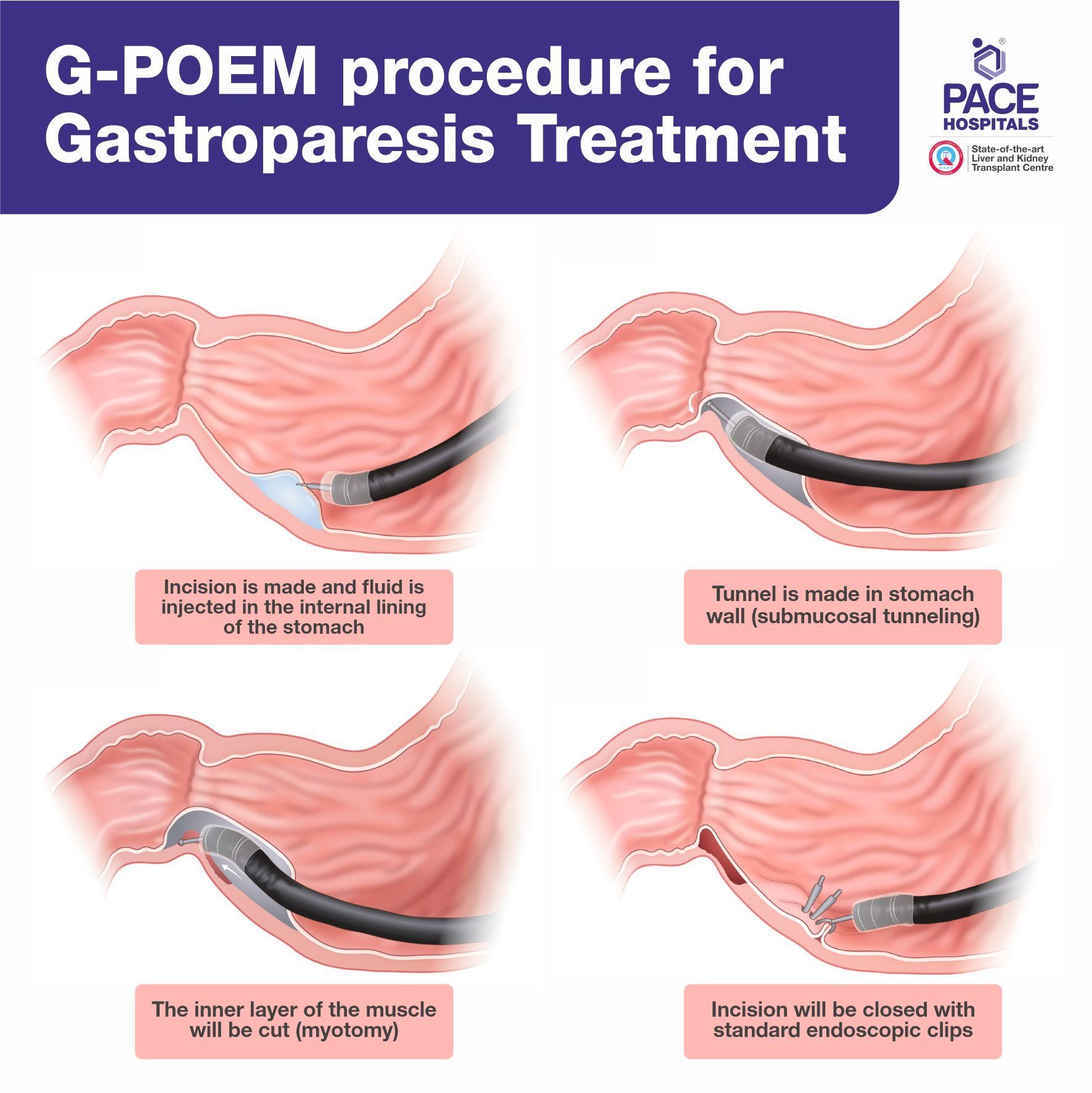 Gastric Peroral Endoscopic Myotomy G-POEM for gastroparesis treatment