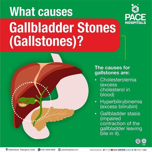 gallstones in poop