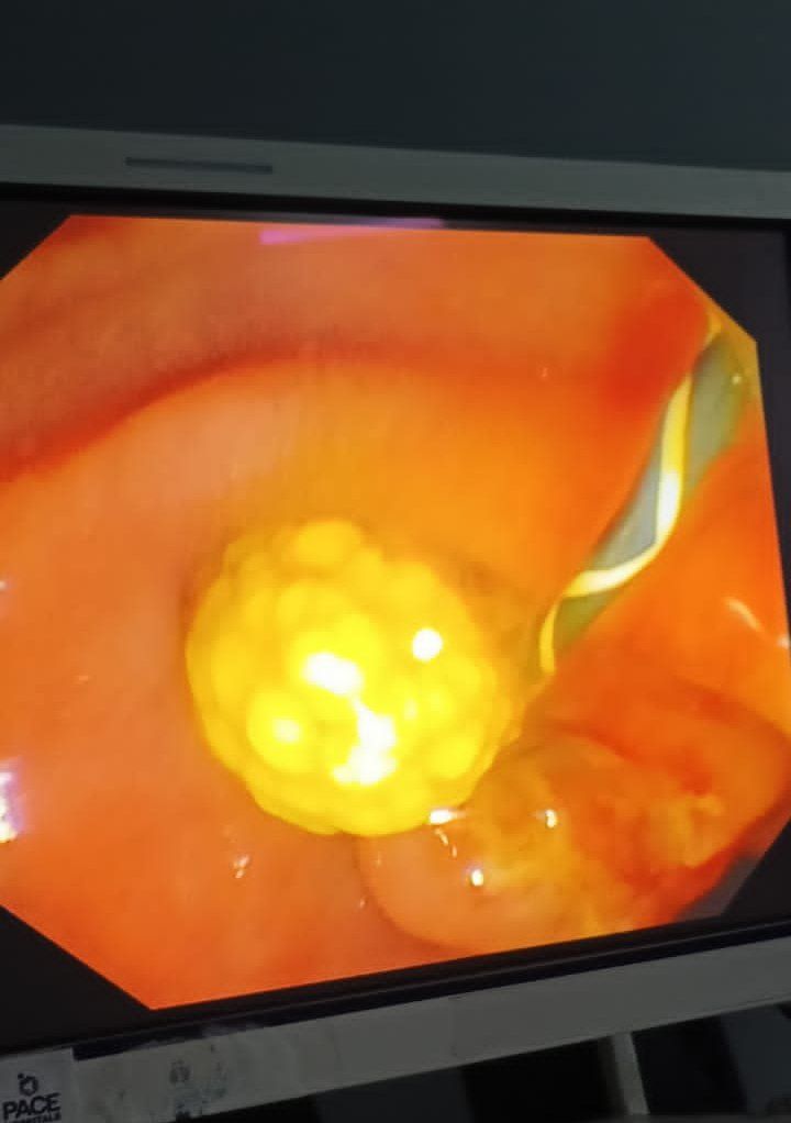 Gallstone in Pregnancy, leading to Jaundice